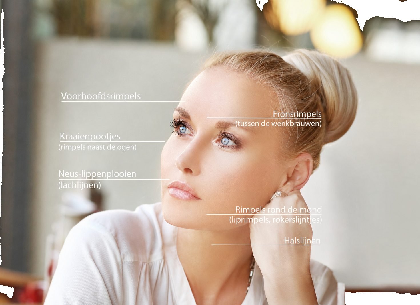 Behandelzones voor botulinetoxine