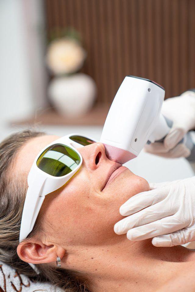 Laserontharing gezicht