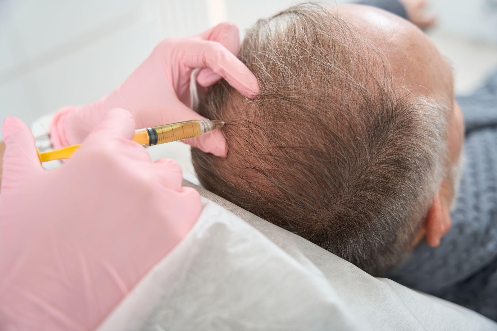 PRP injectie hoofdhuid