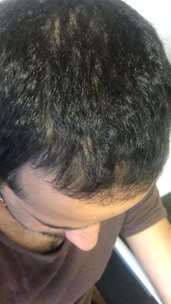 PRP behandeling haar na foto