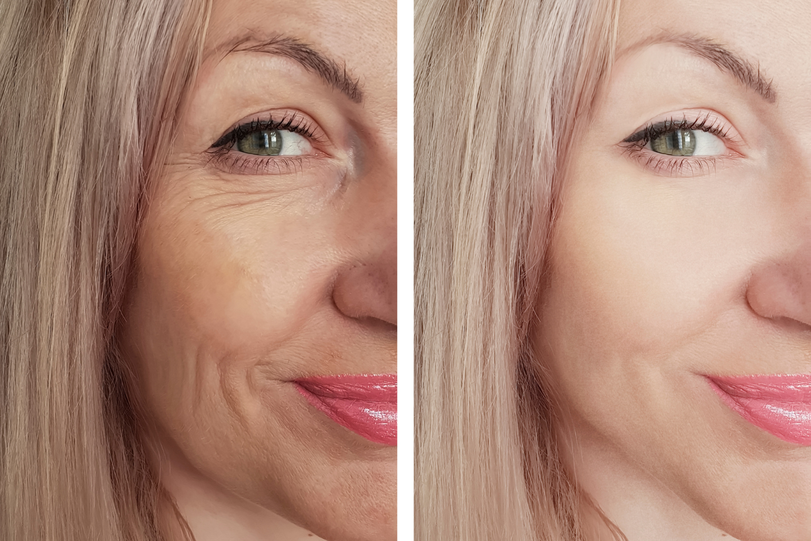 Face Care Clinic Filler Botox 11