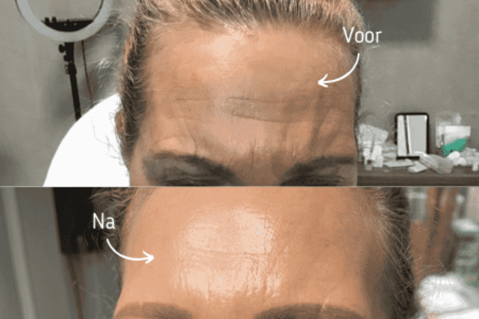 Botox voor voorhoofdrimpels