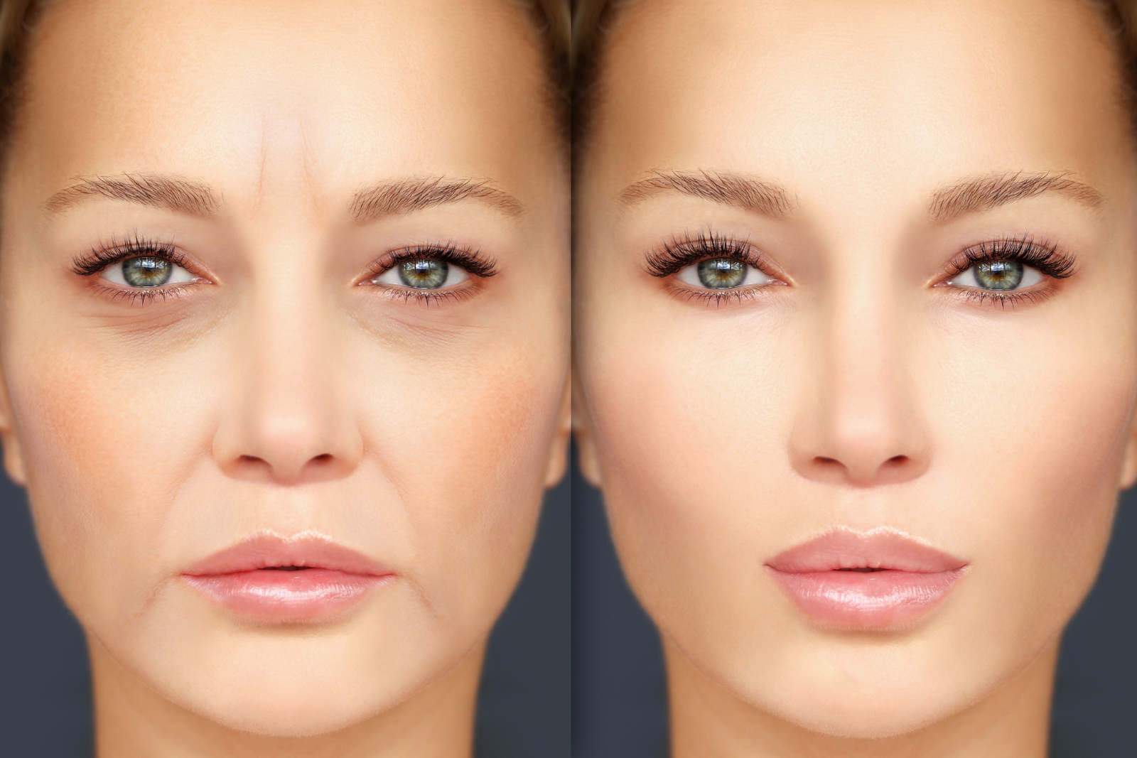 Face care clinic Neus-lippenplooi filler behandeling