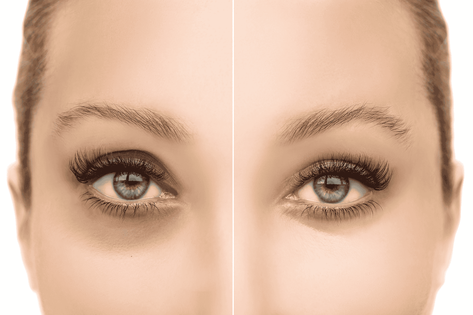 Traangoot fillers Venlo