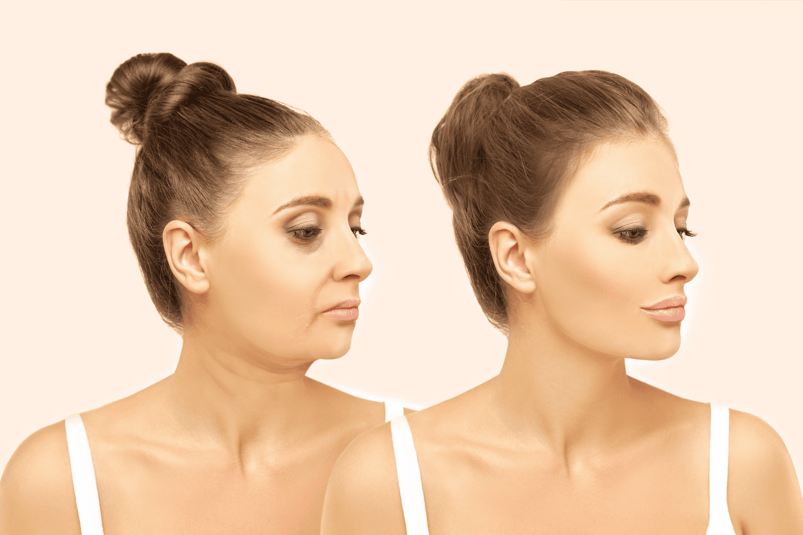 Kaaklijn fillers Venlo