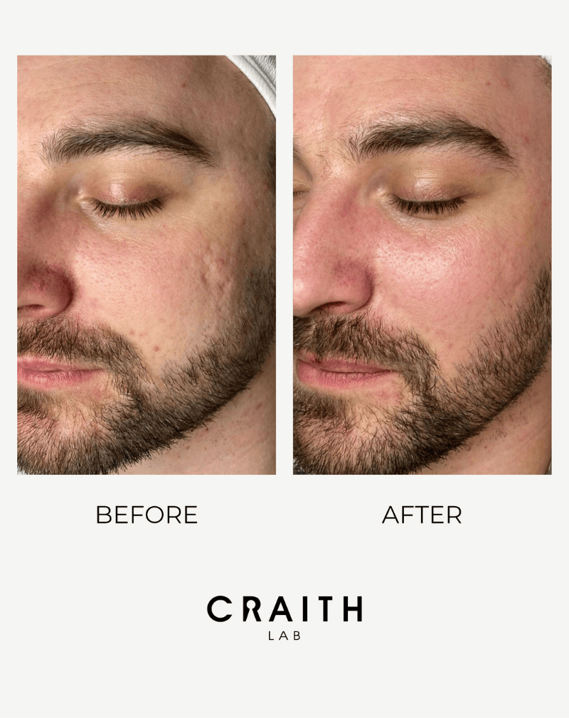 Voor en na resultaat van Craith Lab anti-aging behandeling waarbij rimpels en fijne lijntjes zichtbaar zijn verminderd.