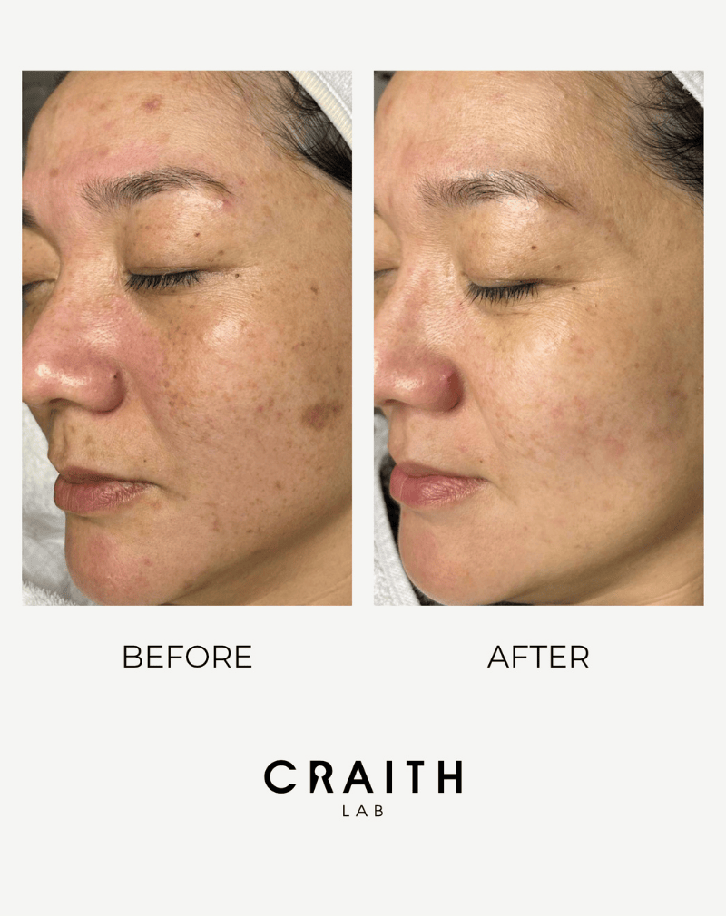 Huidtransformatie van een onzuivere huid naar een egale, rustige huid met Craith Lab Blue Line producten.