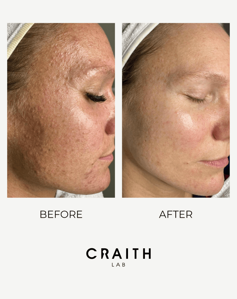 Voor en na foto van Craith Lab behandeling voor het verminderen van pigmentvlekken en het verbeteren van de huidskleur.