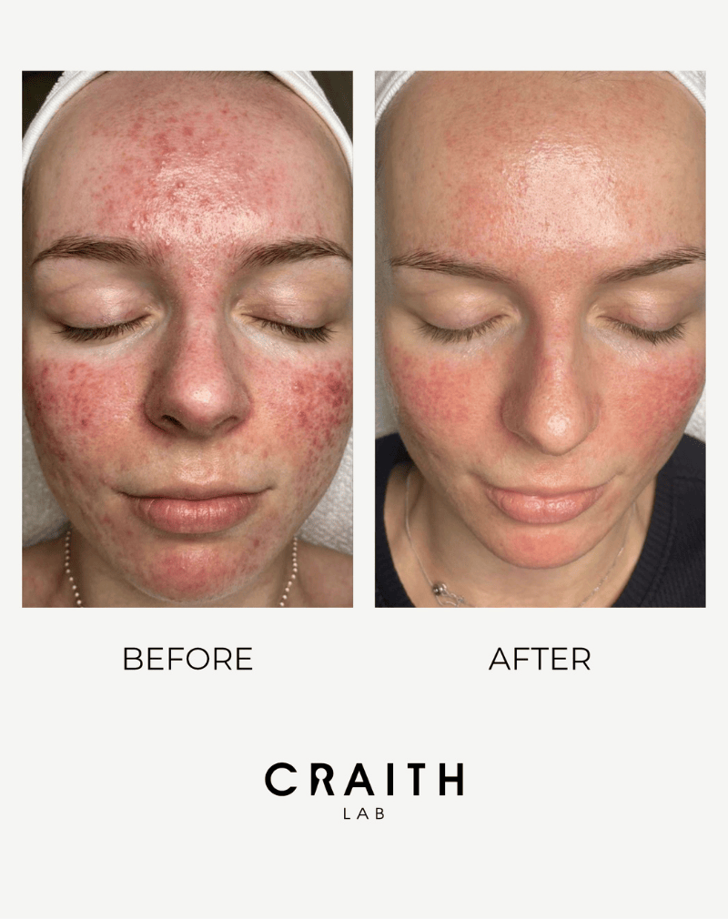 Resultaat van Craith Lab bij een gevoelige huid: zichtbare vermindering van roodheid en irritatie.