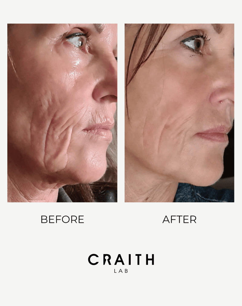 Verstrakking van de kaaklijn en verbeterde huidelasticiteit na een kuur met Craith Lab Gold of Black Line.