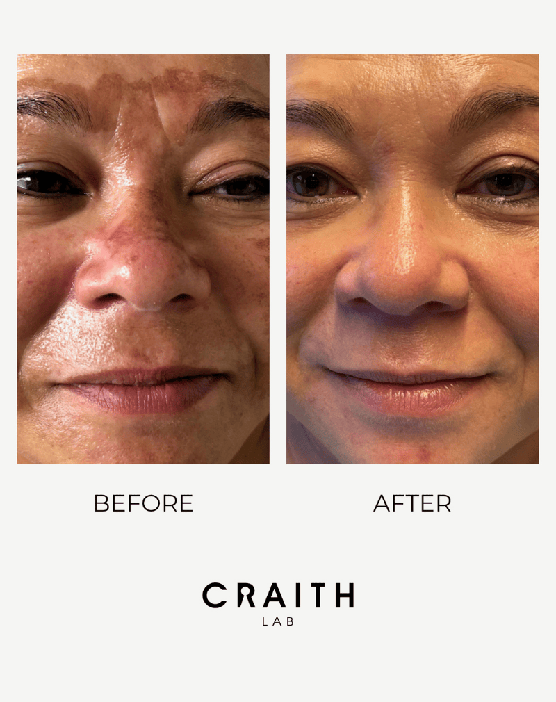 ALT-tekst: Detailfoto van verbeterde huidstructuur en verfijnde poriën door het gebruik van Craith Lab skincare.