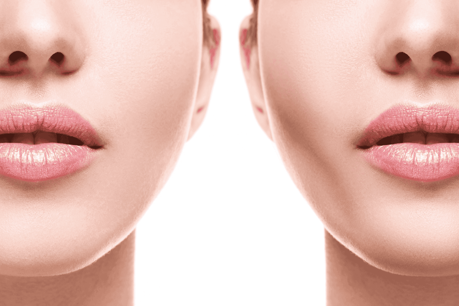 Voor en na resultaat van jukbeenderen fillers behandeling