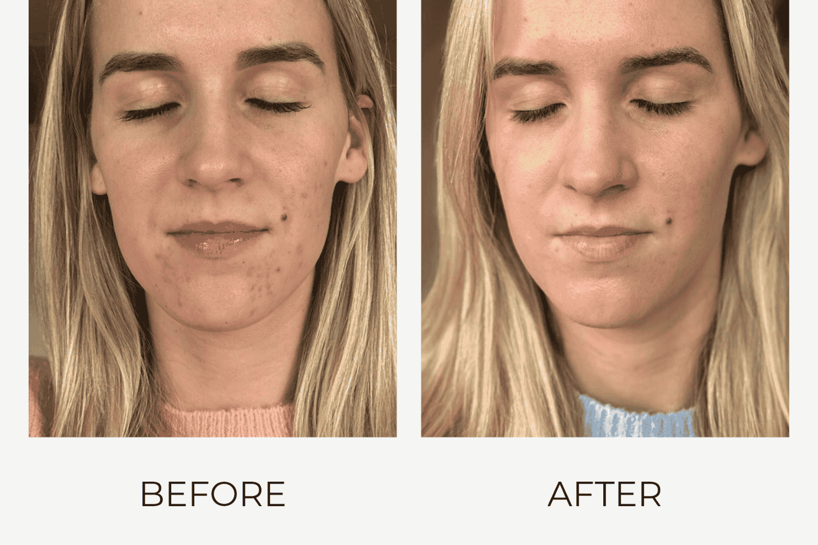 Voor en na resultaat van huidverbetering met Craith Lab epigenetische skincare met zichtbaar egalere en stralendere huid.