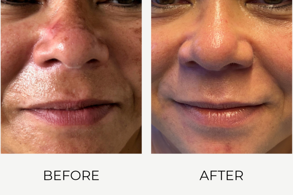 Huidstructuur verbeteren