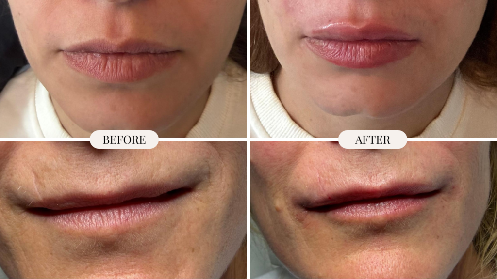 Resultaat van een lip filler behandeling