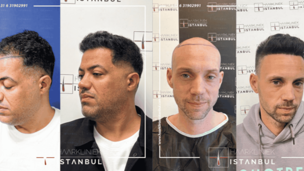 haartransplantatie voor en na