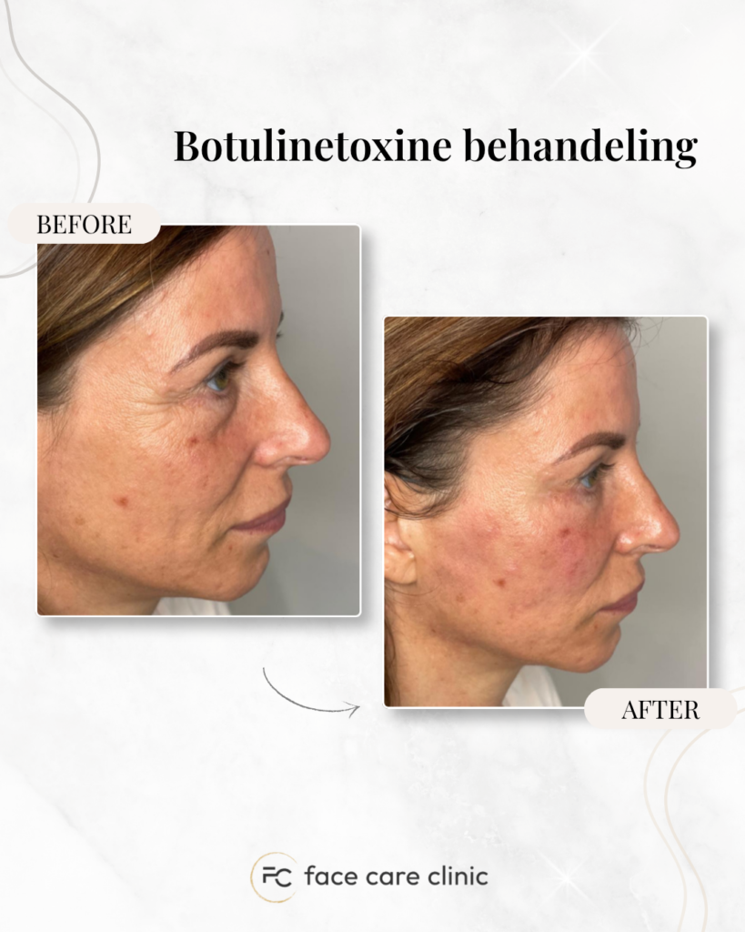 Botuline toxine voor en na resultaat