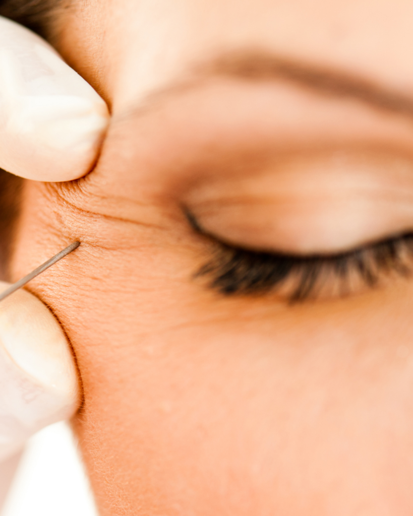 Injectables kraaienpootjes kosten
