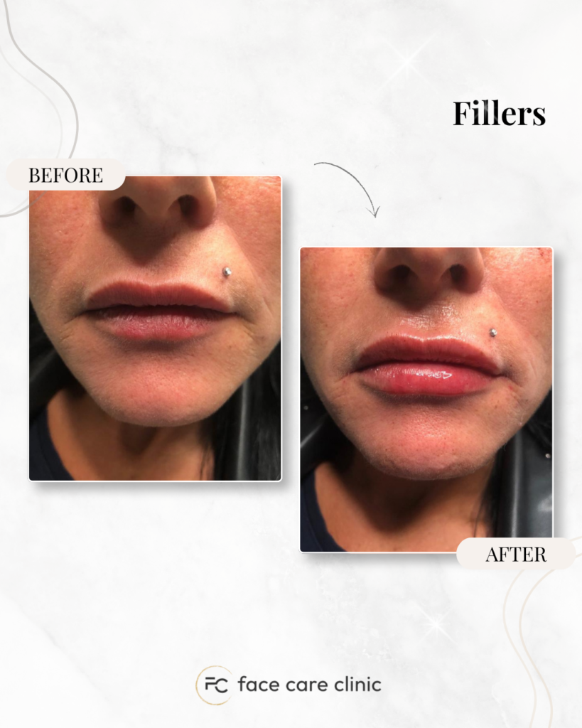 Filler behandeling voor en na