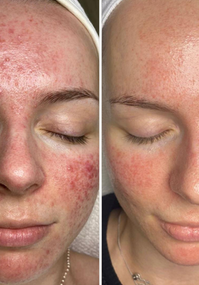 Voor en na resultaten gezichtsbehandeling